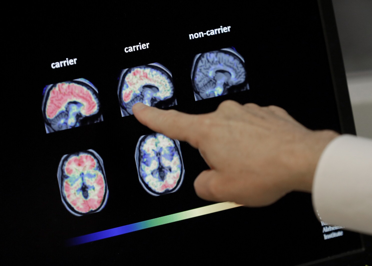 Un grupo de expertos de todo el mundo ha propuesto una nueva forma para definir y diagnosticar la obesidad, reduciendo el énfasis en el controversial índice de masa corporal (IMC) con la esperanza de poder identificar de mejor forma a aquellas personas que necesitan tratamiento para la enfermedad provocada por el exceso de grasa corporal.