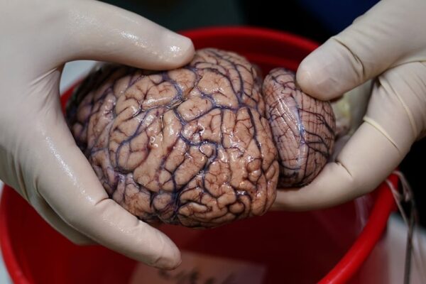 Una deficiencia del metal litio en el organismo podría ser un factor clave para el desarrollo de la demencia en los pacientes de Alzheimer, según revela un nuevo estudio pionero.