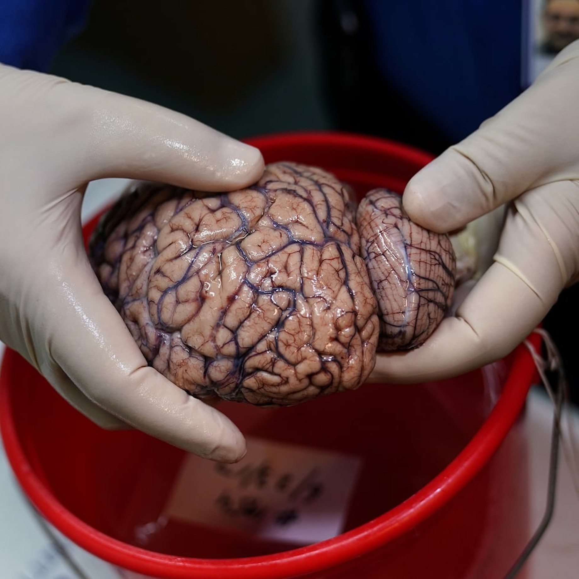 Una deficiencia del metal litio en el organismo podría ser un factor clave para el desarrollo de la demencia en los pacientes de Alzheimer, según revela un nuevo estudio pionero.